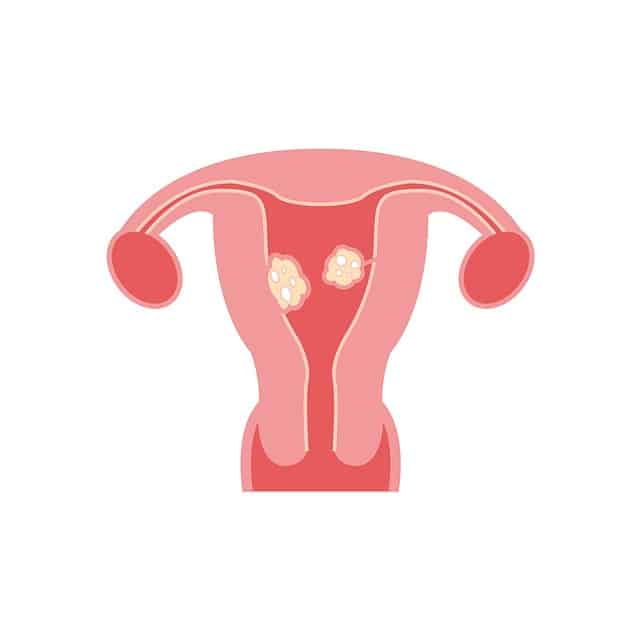 What are fibroids and their symptoms?
